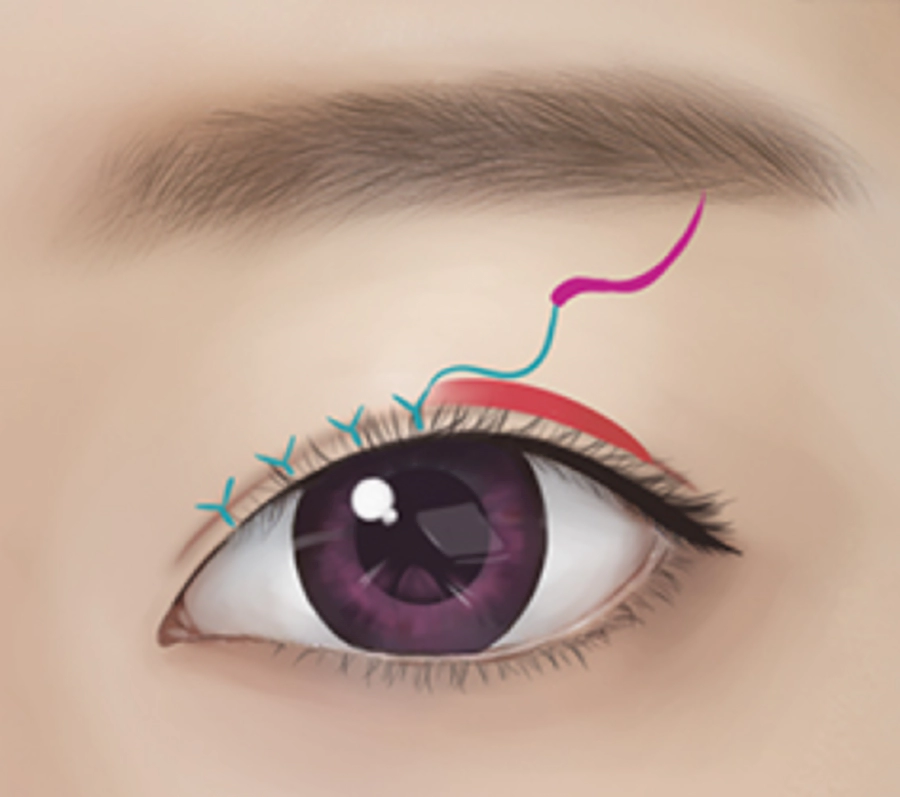 쌍커풀 라인을 낮게 만드는 남자 눈 성형.