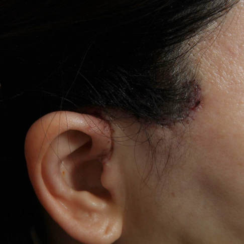Suture removal on day 7 after a mini facelift for lifting.