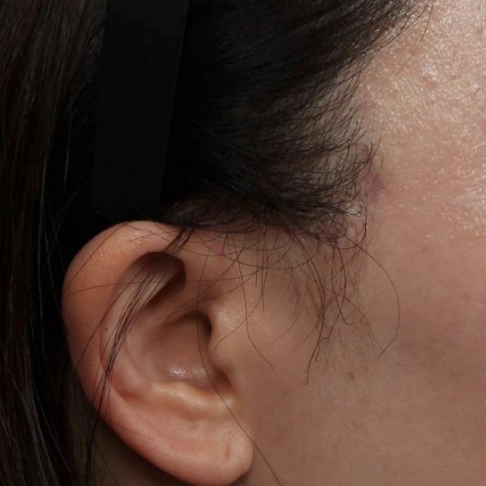 Side of the face two months after a mini facelift, with the scar fading.