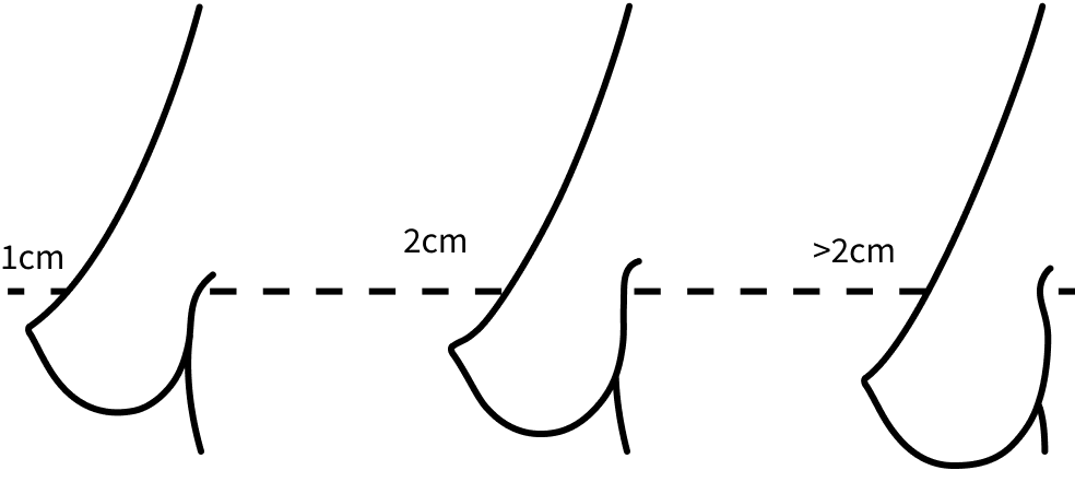 Korean breast lift diagram showing stage 3 sagging breast with nipple descent measured at 1cm, 2cm, and more than 2cm below the crease.