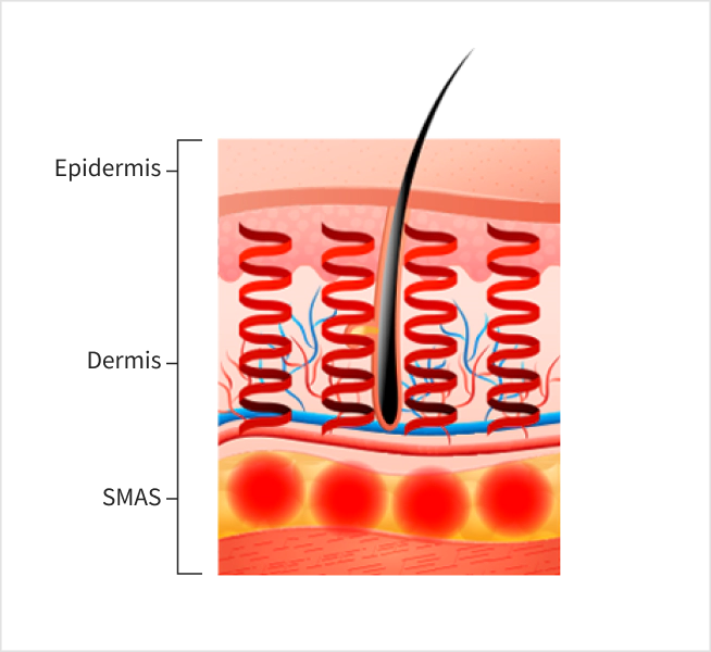 Image of skin layers for Titanium lifting.