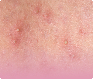 Image of comedone, millet acne.