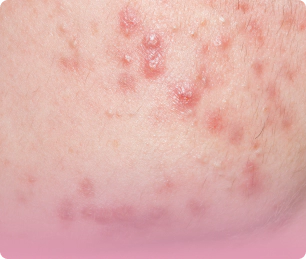 Image of inflammatory acne.