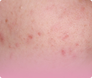 Image of red marks and pigmentation after acne.