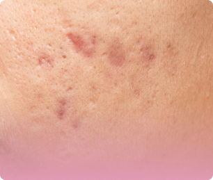 Image of acne scars.