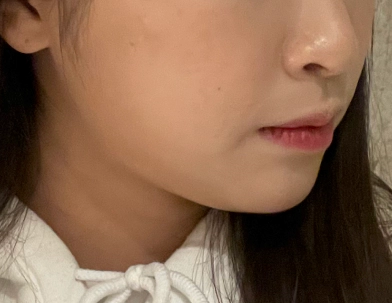 Image 1 of before botox.