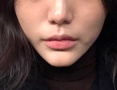 Image 2 of before botox.