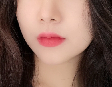 Image 2 of after botox.