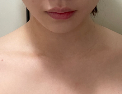 Image 3 of before botox on trapezoid.