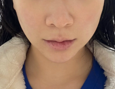 Before filler procedure the face has sunken areas and low volume.