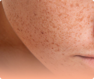 Freckles that need skin brightening.