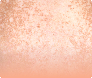 Pigmentation that need skin brightening.