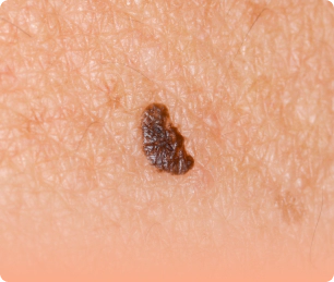 Solar lentigo that need skin brightening.