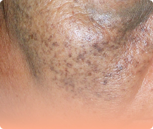 Nevus of Ota that need skin brightening.