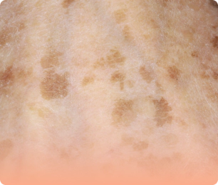 Dermal pigmentation that need skin brightening.