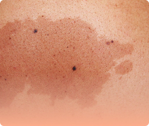 Refractory pigmentation that need skin brightening.