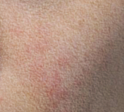 Close up view of skin with dry skin and dead skin cell before Exosome.
