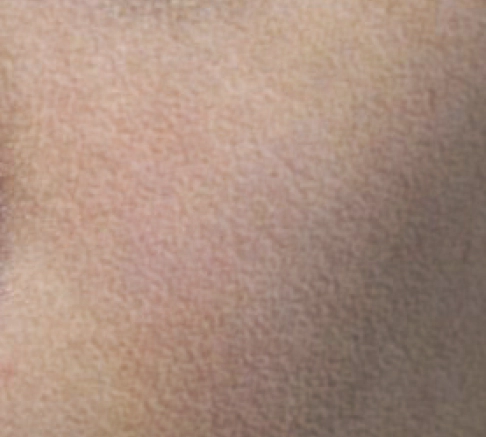 Close up view of skin with improved skin after Exosome.