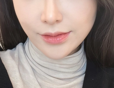 Woman who has had filler in several areas of the face.