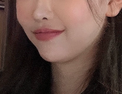 before filler procedure.