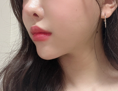 Filler procedure in smile line and lips.