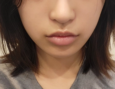 Photo of woman before fillers.