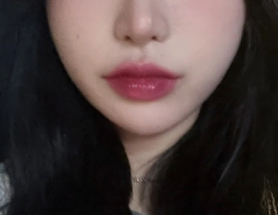 Photo of woman after filler procedure.