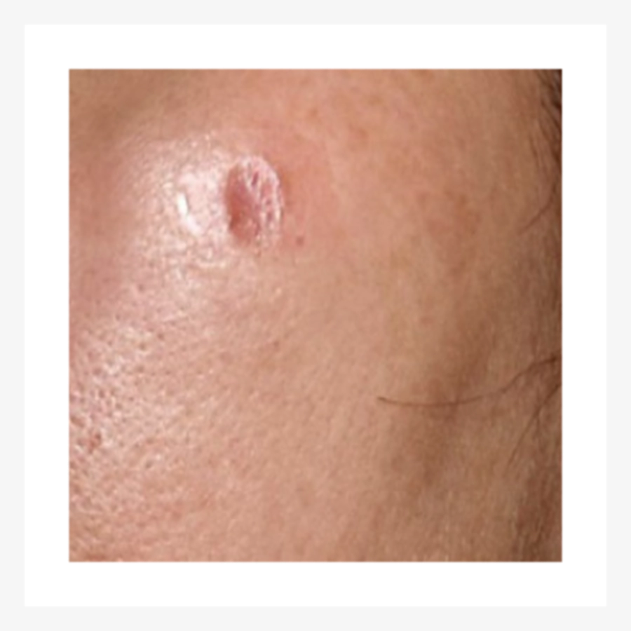 Skin with a deep scar before Juvelook.