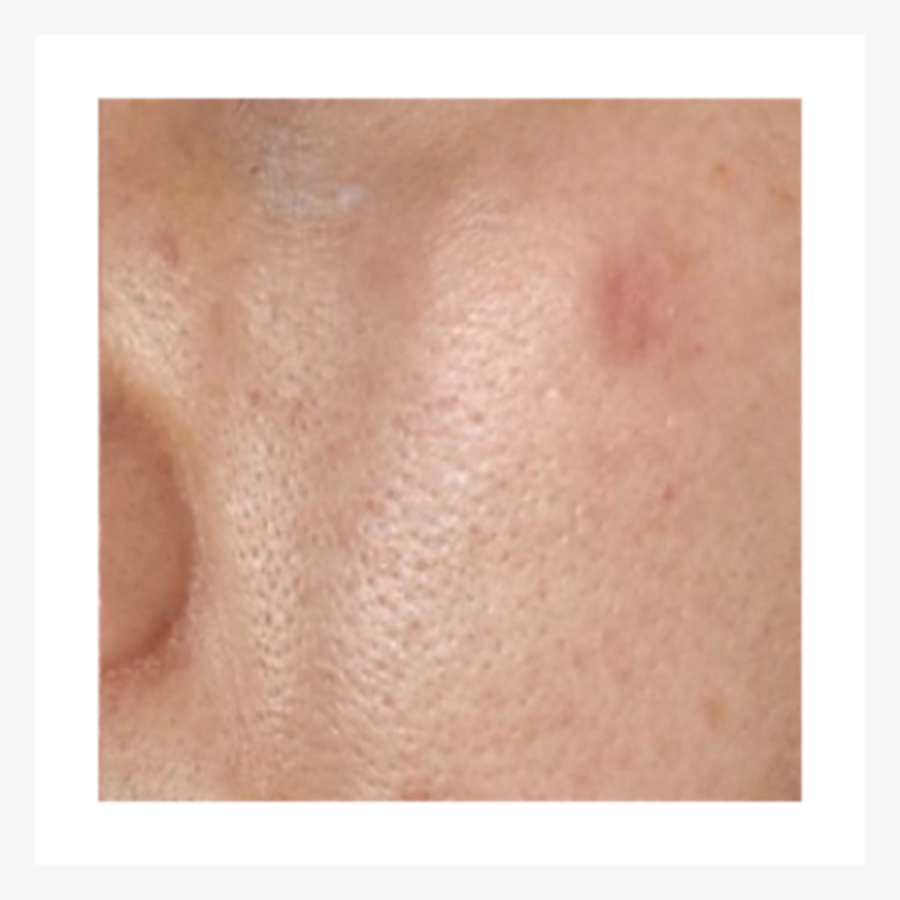 Skin with a shallow scar that is almost gone after Juvelook.