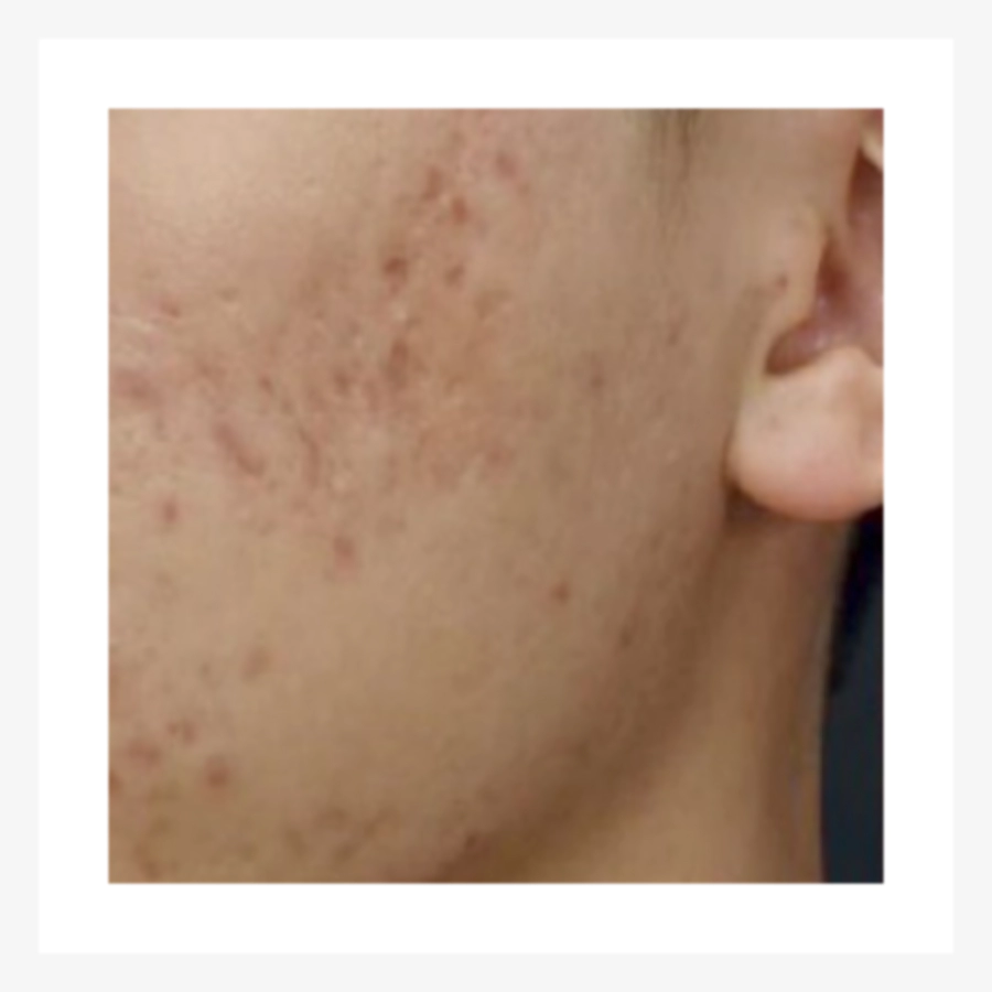 Acne skin before Juvelook.