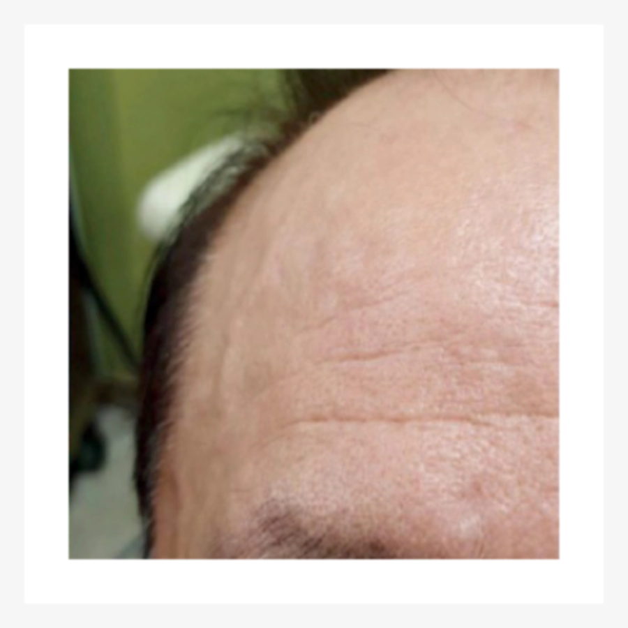 Middle aged man forehead wrinkles after Juvelook.