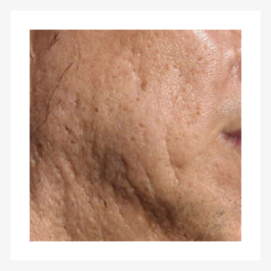 Skin with fine wrinkles and sagging that is good candidate for Juvelook.