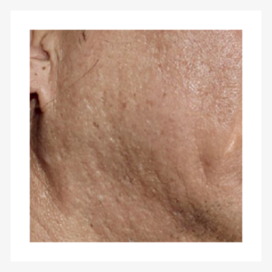 Skin with less fine wrinkles and more volume after Juvelook.