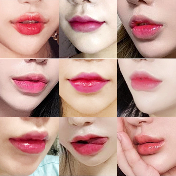 MINE Plastic Surgery | Lip filler designer procedure