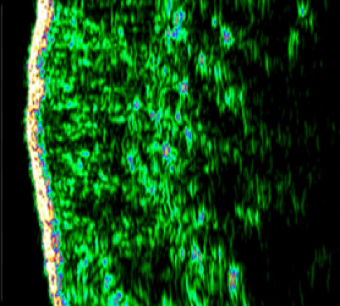 Skin density and thickness after Rejuran.