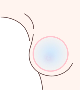 가슴 확대시 가슴 포켓이 보형물 보다 작아 보형물이 펴지지 않는다.