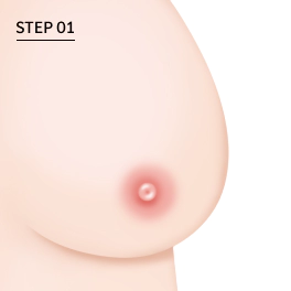 Korean breast reduction step 1 illustration showing the initial breast shape before incision.