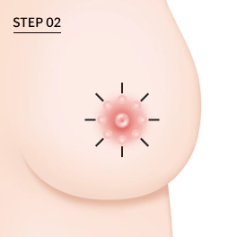 Korean breast reduction donut incision method illustration.
