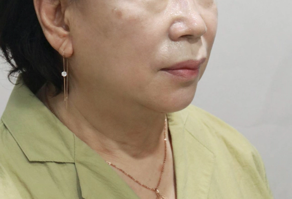 Face and neck lift patient at MINE plastic surgery.