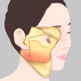 관자놀이 헤어라인에서 귀 뒤까지 절개하는 안면거상, 목거상 방법