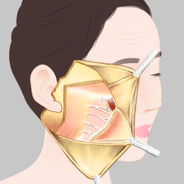 Face and neck lift surgery method for lifting smas layer.