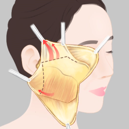 Face and neck lift smas fixation.