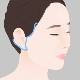 Face and neck lift incision line.