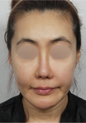 Female that needs Korean facelift due to her deep smile lines and marionette lines from aging.