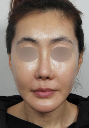 Female looks 10 years younger after Korean facelift and necklift.