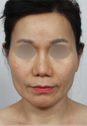 Middle aged woman who needs Korean facelift.