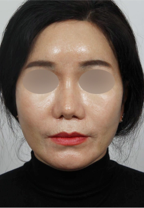 Middle aged woman who got Korean facelift done to improve her face sagging.