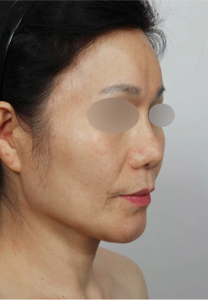 Midde aged Korean female who needs Korean facelift and neck lift in order to improve her sagging smile line and jawline.