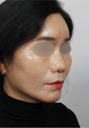 Middle aged female who looks much more youthful and rejuvenated after Korean facelift and neck lift surgery.