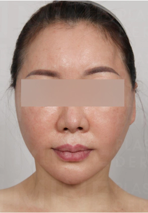 A lifted face after going under Korean facelift and neck lift simultaneously.